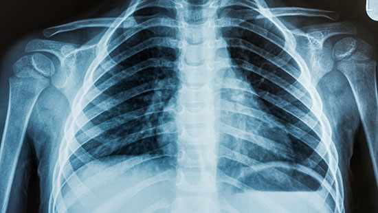 Chest x-ray of the lungs