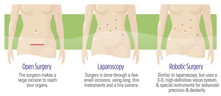 image diagram showing incision marks for open surgery, laparoscopy and robotic surgery