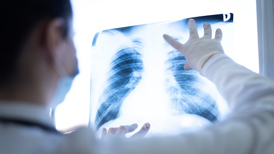 Doctor examining lung X-rays