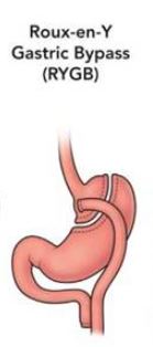 gastric bypass graphic