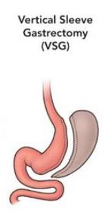 gastric sleeve graphic