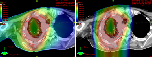 proton therapy images