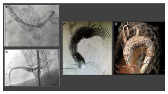 An image combining four images of the Endo-Bentall device, which was deployed in a patient by University of Maryland Medical Center's aortic team.