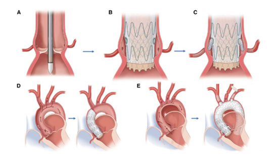 An illustration of the Endo-Bentall repair device inside the aorta.