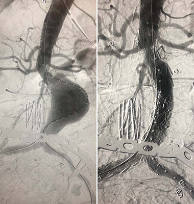 (A) An abdominal aortic aneurysm (AAA) before repair. (B) The same AAA after deployment of the TREO endograft.