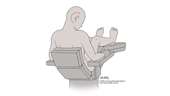 An illustration of the patient in a sitting position, showing where the brainstem cavernous malformation was located on the right side of the head behind the ear.
