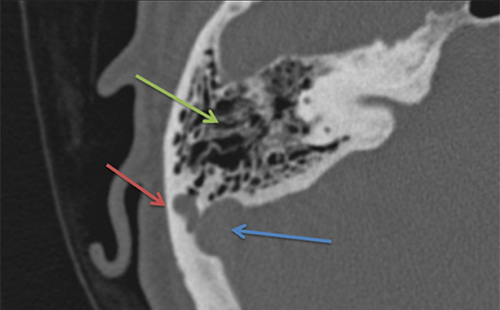Axial CT of right temporal bone