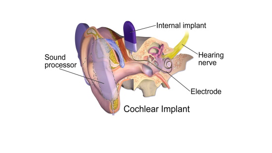 Illustration of how cochlear implants work