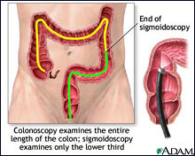 Medical illustration of a colonoscopy