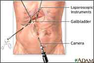 Medical Illustration of a gall bladder removal surgery