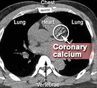 Medical scan of coronary calcium