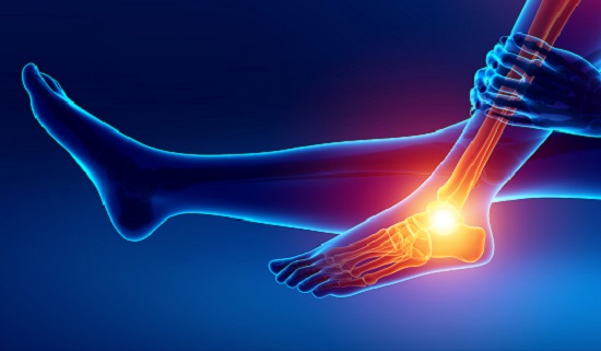 Illustration showing ankle arthritis with X-ray