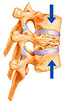 Illustration showing a fractured vertebra