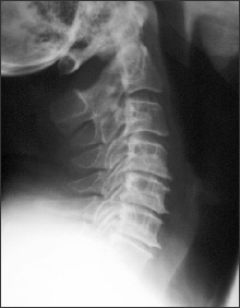 X-ray Cervical disc Degeneration