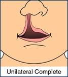 Medical illustration of a complete unilateral