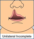 Medical illustration of an incompete unilateral