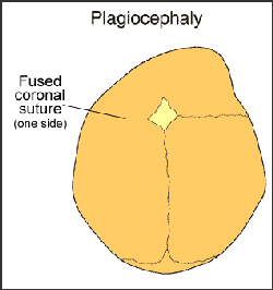 Medical illustration of plagiocephaly