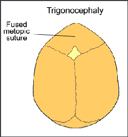 Medical illustration of trigonocephaly