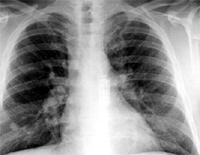 Chest X-Ray showing multiple nodules. 