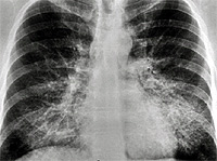 Chest X-Ray showing bilateral 
