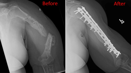 Two x rays showing before and after a fracture was set