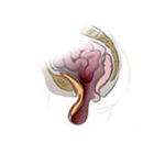 Medical illustration of a vaginal prolapse