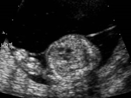 Scan of the baby becoming a stuck twin