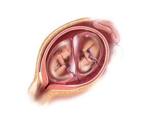 image of normal monochorionic twins sharing a single placenta