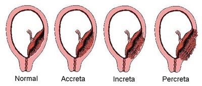 Images of a placenta in accreta, increta and percreta