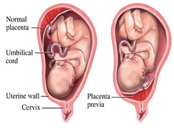 An image of a baby suffering from placenta previa