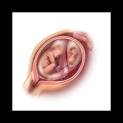 image of TTTS monochorionic twins sharing a single placenta