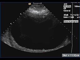 Ultrasound image of amniocentesis amniodrainage