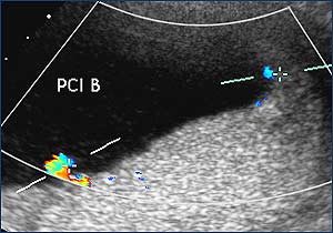 Ultrasound image of the placental cord insertion of each baby (colored points). 