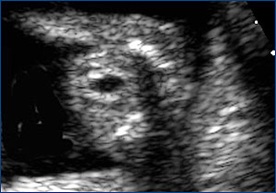Ultrasound image of the donor bladder beginning to fill (small black circle in the middle of the abdomen) after treatment
