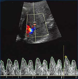 Scan of normal cardiac function with all blood flow forward 