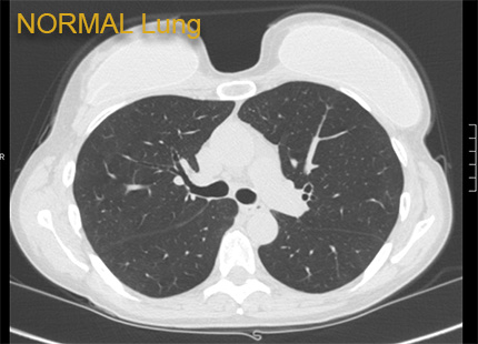Normal lung x ray