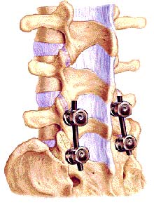 Lumbar interbody fusion