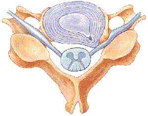 Pinched Nerve from a Herniated Disc