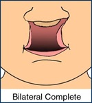 Medical illustration of a complete bilateral